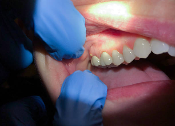 Best Emergency Treatment for Dental Infections or Abscesses in Weyauwega, WI